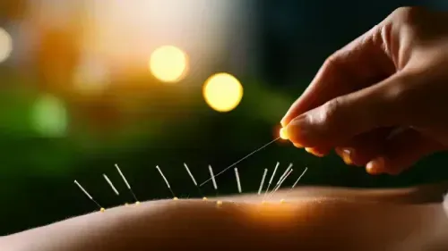 What You Need to Know About Acupuncture